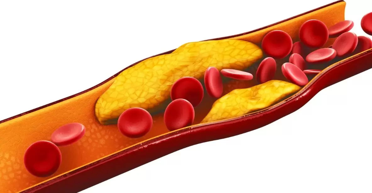 The reason for taking MiCardium capsules is vascular atherosclerosis